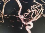 凌源市中心醫(yī)院開展全腦血管造影術(shù)，為患者帶來福音（趙海霞 李蔚藍(lán)）