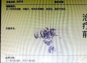 北票市中心醫(yī)院腫瘤血液科鞘內(nèi)注射技術(shù)點(diǎn)亮肺癌顱腦轉(zhuǎn)移患者生命之光