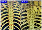 北票市中心醫(yī)院成功救治連枷胸患者