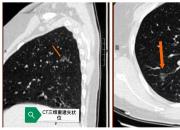 建科十周年獻(xiàn)禮：朝陽(yáng)四院?jiǎn)慰谉o(wú)管胸腔鏡手術(shù)惠及肺結(jié)節(jié)患者（勞海軍 孫冬梅）